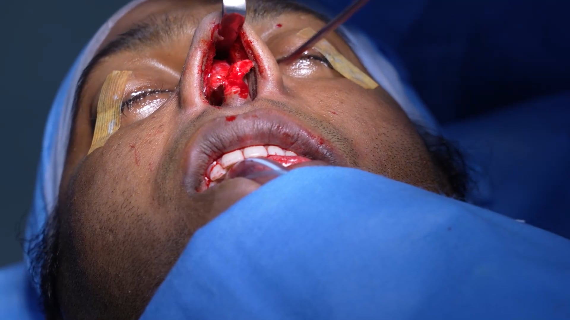 Man Rhinoplasty Surgery